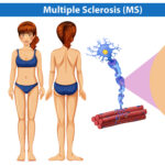 Illustrazione dell'anatomia umana della Sclerosi Multipla